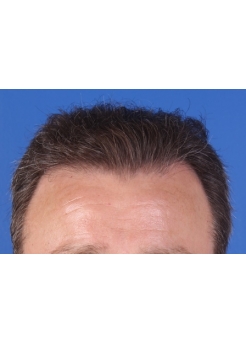 After Hair Transplant&nbsp;Front